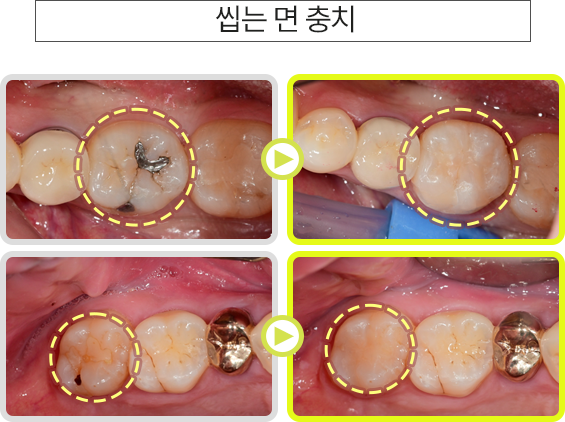 씹는 면 충치