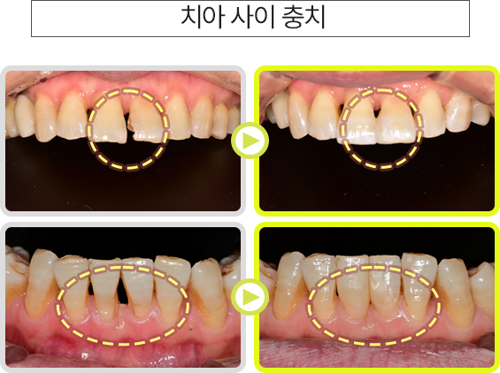 치아 사이 충치