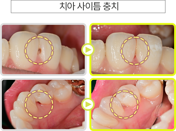 치아 사이틈 충치