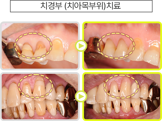 치경부(치아목부위) 치료