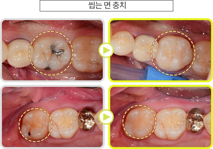 씹는 면 충치