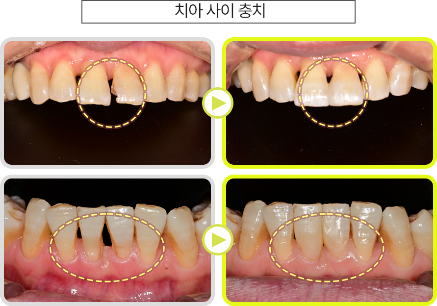 치아 사이 충치