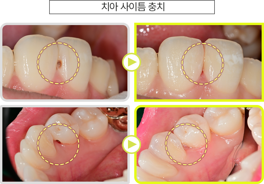 치아 사이틈 충치