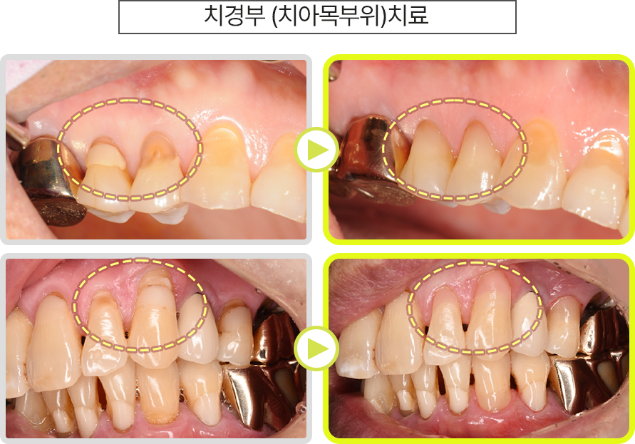 치경부(치아목부위) 치료